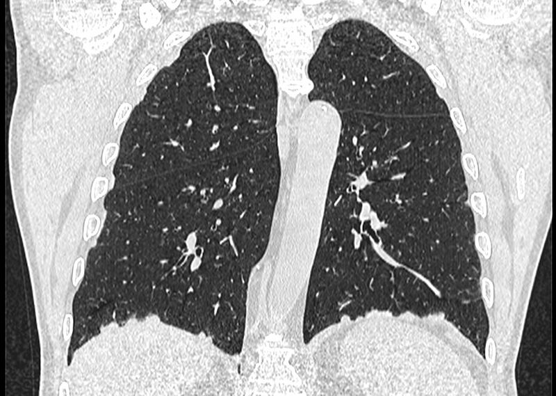 File:Asbestos pleural placques (Radiopaedia 57905-64872 Coronal lung window 195).jpg