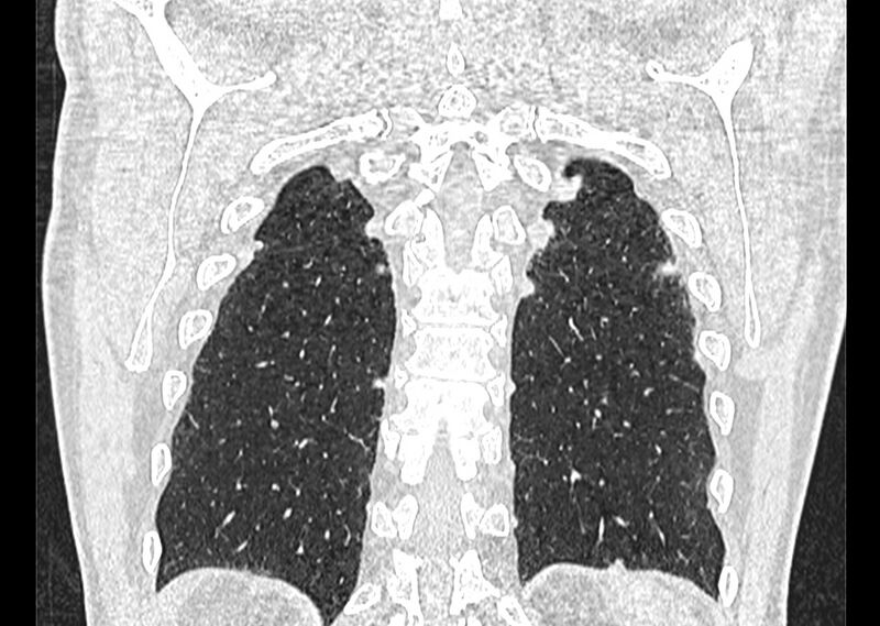 File:Asbestos pleural placques (Radiopaedia 57905-64872 Coronal lung window 246).jpg