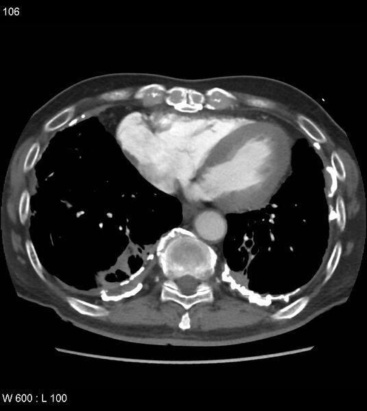 File:Asbestos related lung and pleural disease (Radiopaedia 14377-14301 D 42).jpg