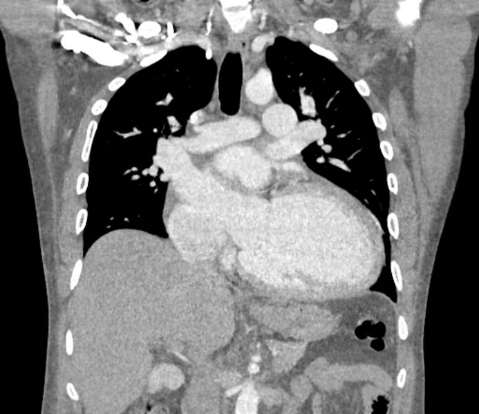 File:Ascending aortic aneurysm (Radiopaedia 86279-102297 B 31).jpg