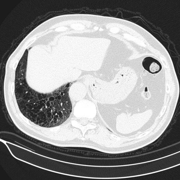 File:Aspergilloma (Radiopaedia 24521-24804 Axial lung window 25).jpg