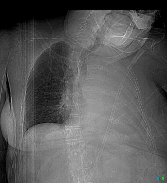File:Aspirated food bolus obstruction of left main bronchus (Radiopaedia 29432-29904 Anterior scout view 1).jpg