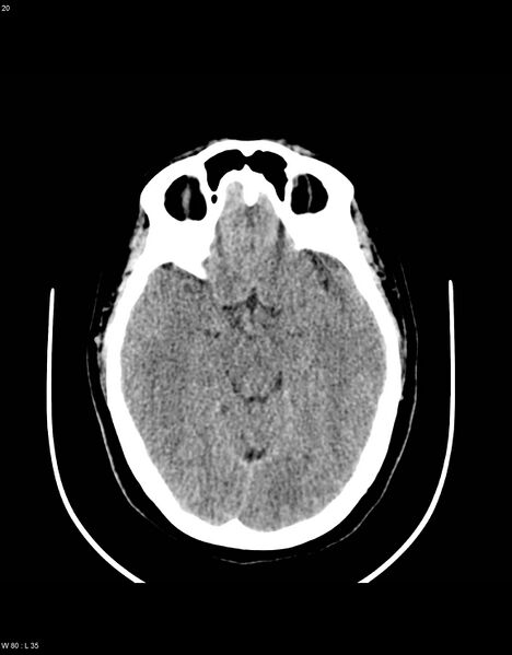File:Astroblastoma (Radiopaedia 39792-42216 Axial non-contrast 19).jpg