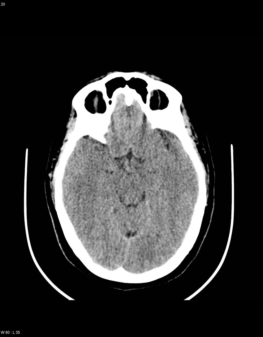 Astroblastoma (Radiopaedia 39792-42216 Axial non-contrast 19).jpg
