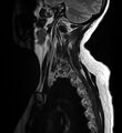 Astrocytoma - spinal cord (Radiopaedia 69769-79758 Sagittal T2 12).jpg