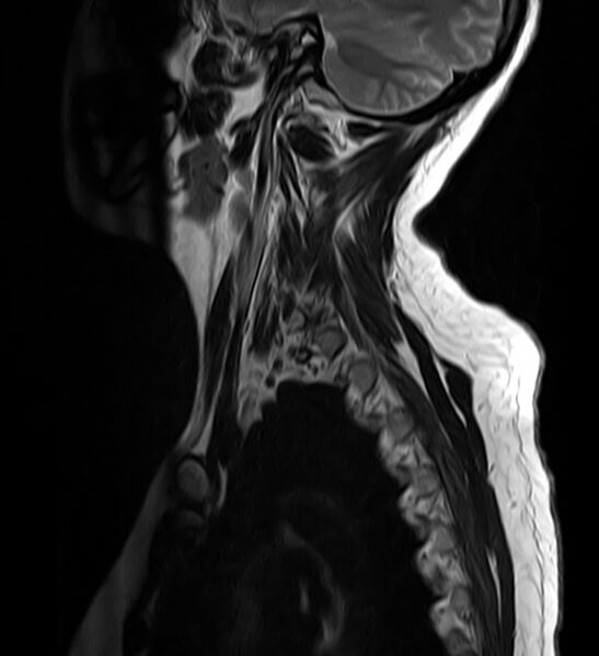 File:Astrocytoma - spinal cord (Radiopaedia 69769-79758 Sagittal T2 12).jpg
