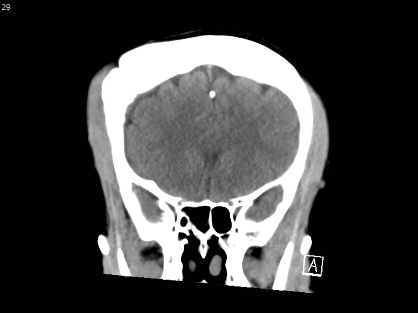 Atypical meningioma - intraosseous (Radiopaedia 64915-73867 B 28).jpg