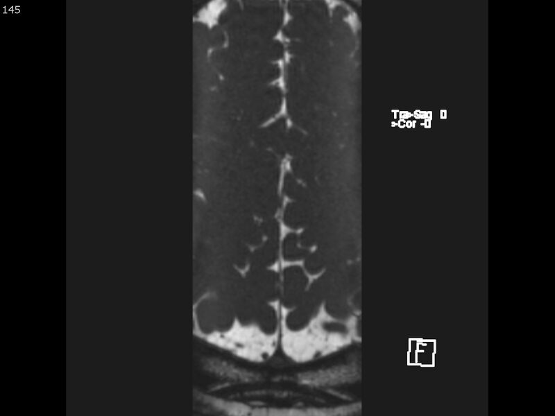 File:Atypical meningioma - intraosseous (Radiopaedia 64915-74572 Axial CISS 145).jpg