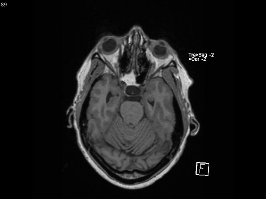 Atypical meningioma - intraosseous (Radiopaedia 64915-74572 Axial T1 89).jpg