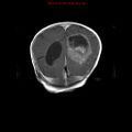 Atypical teratoid rhabdoid tumor (Radiopaedia 10712-11183 Coronal T1 C+ 4).jpg