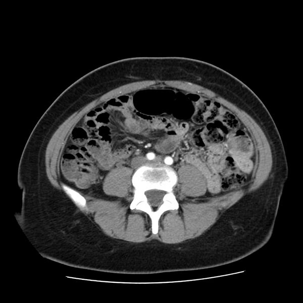 File:Autosomal dominant polycystic kidney disease (Radiopaedia 23061-23093 B 44).jpg