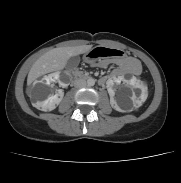 File:Autosomal dominant polycystic kidney disease - early onset (Radiopaedia 40734-43387 A 41).jpg