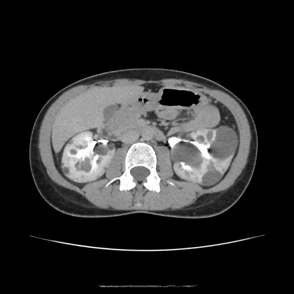 File:Autosomal dominant polycystic kidney disease - early onset (Radiopaedia 40734-43387 D 8).jpg