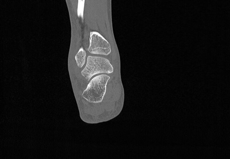 File:Avulsion fractures of talus and calcaneus (Radiopaedia 48277-53155 Coronal bone window 74).jpg
