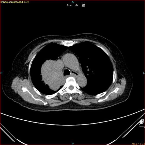 File:Azygos vein aneurysm (Radiopaedia 77824-90130 A 22).jpg