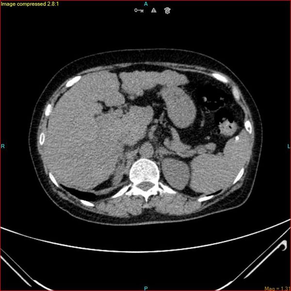 File:Azygos vein aneurysm (Radiopaedia 77824-90130 A 54).jpg