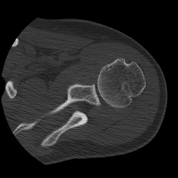 File:Bankart lesion (Radiopaedia 22771-22798 Axial bone window 19).jpg