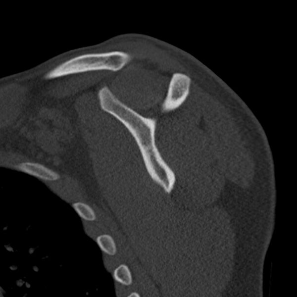 File:Bankart lesion (Radiopaedia 22771-22798 Sagittal bone window 38).jpg