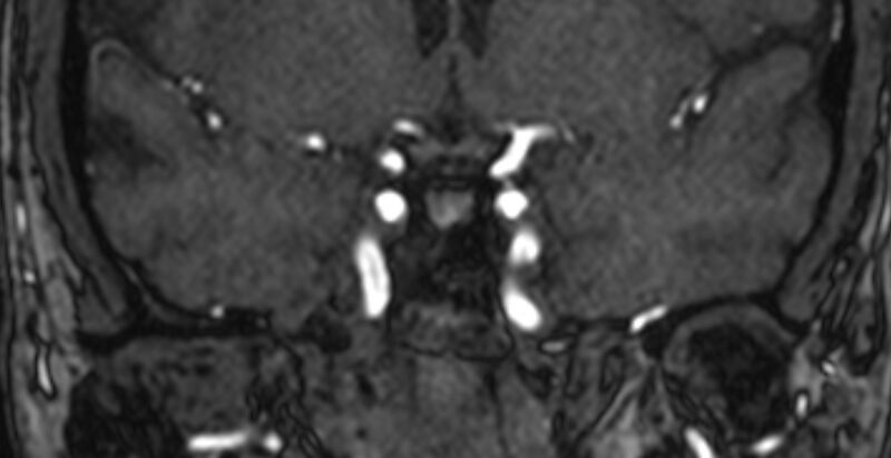 File:Basilar artery fenestration (Radiopaedia 74537-85455 Coronal MRA TOF 16).jpg