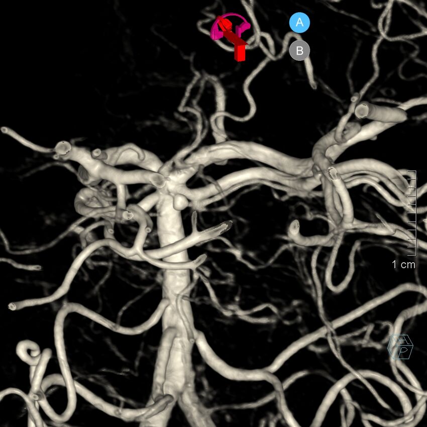 Basilar artery perforator aneurysm (Radiopaedia 82455-97734 3D view left VA 165).jpg
