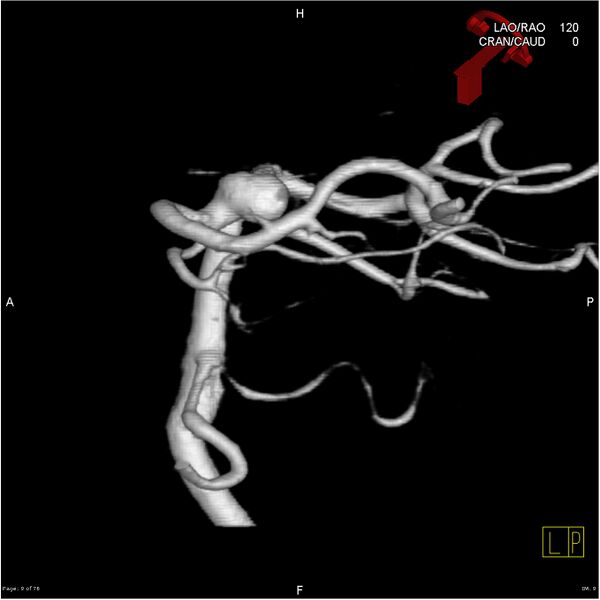 File:Basilar tip aneurysm double balloon remodeling (Radiopaedia 18100-17883 3D rotation 9).jpg