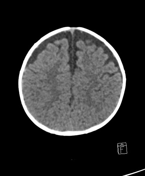 File:Benign enlargement of subarachnoid spaces in infancy (BESS) (Radiopaedia 87459-103795 Axial non-contrast 25).jpg