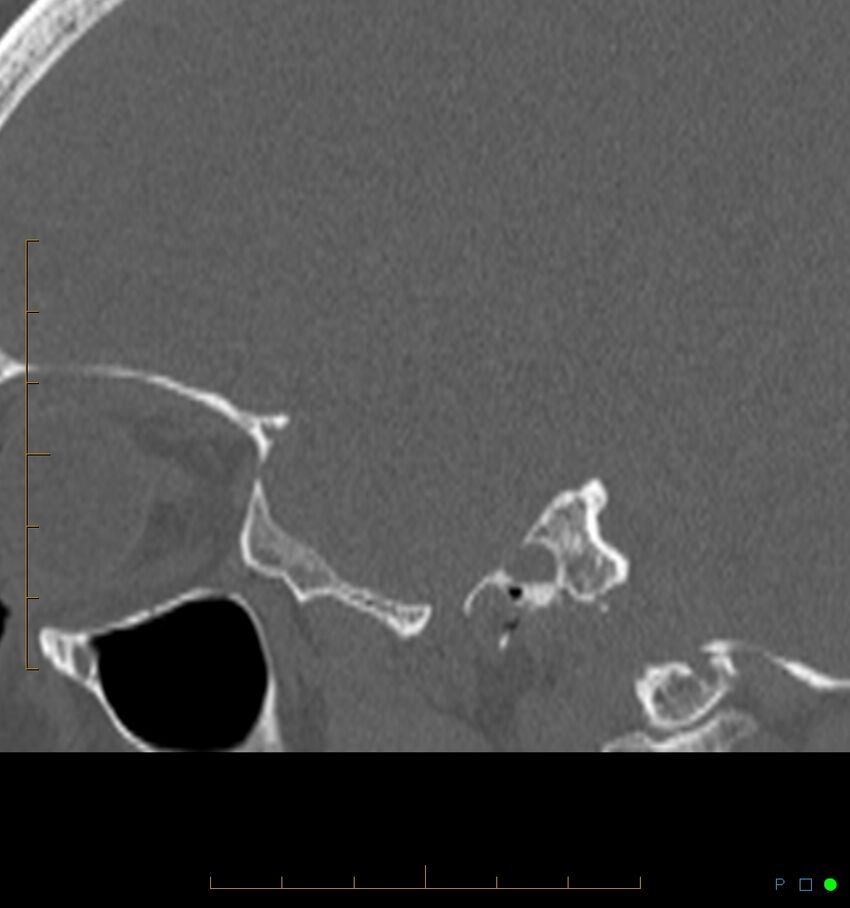 Benign notochordal cell tumor (probable) (Radiopaedia 65475-74546 Sagittal bone window 54).jpg