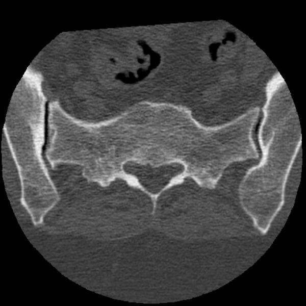 File:Bertolotti syndrome (Radiopaedia 24864-25128 Axial bone window 41).jpg