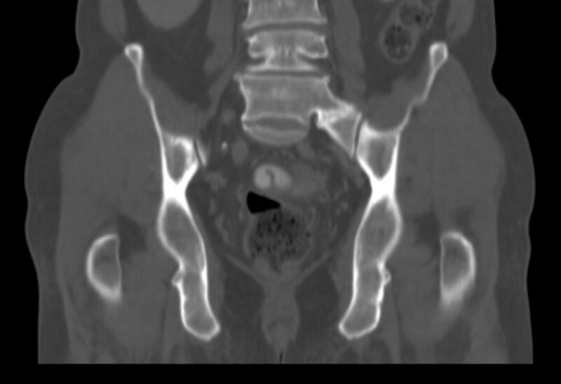 File:Bertolotti syndrome (Radiopaedia 58974-66235 Coronal bone window 16).jpg