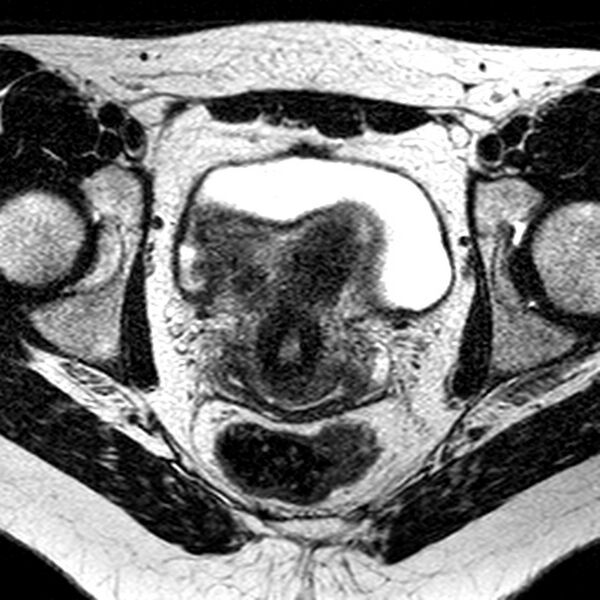 File:Bicornuate uterus (Radiopaedia 11104-11492 Axial T2 17).jpg
