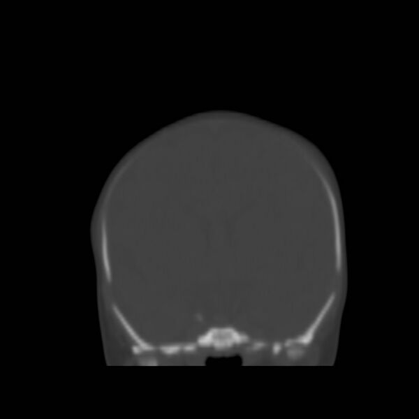 File:Bilateral cephalohematomas and subdural hematomas (Radiopaedia 26778-26929 Coronal bone window 8).jpg