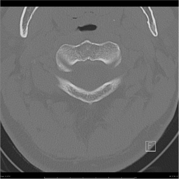 File:Bilateral cervical ribs (Radiopaedia 25868-26017 Axial bone window 11).jpg
