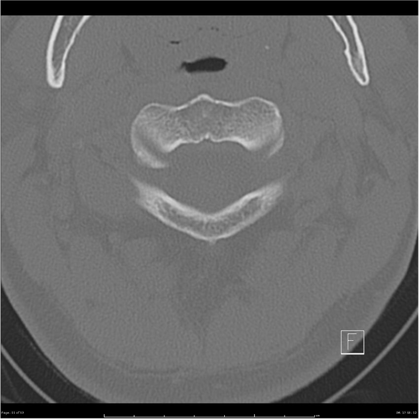 Bilateral cervical ribs (Radiopaedia 25868-26017 Axial bone window 11).jpg