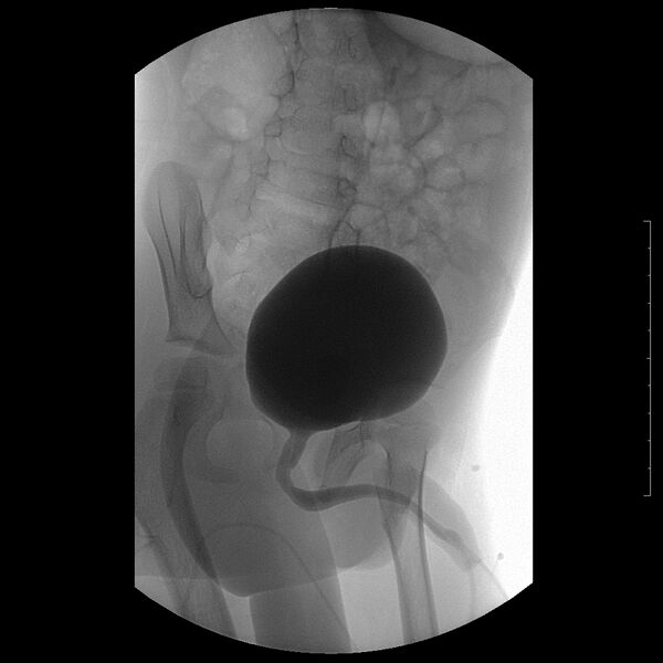 File:Bilateral duplex kidneys with left-sided uterocoele (Radiopaedia 20811-20726 A 2).jpg