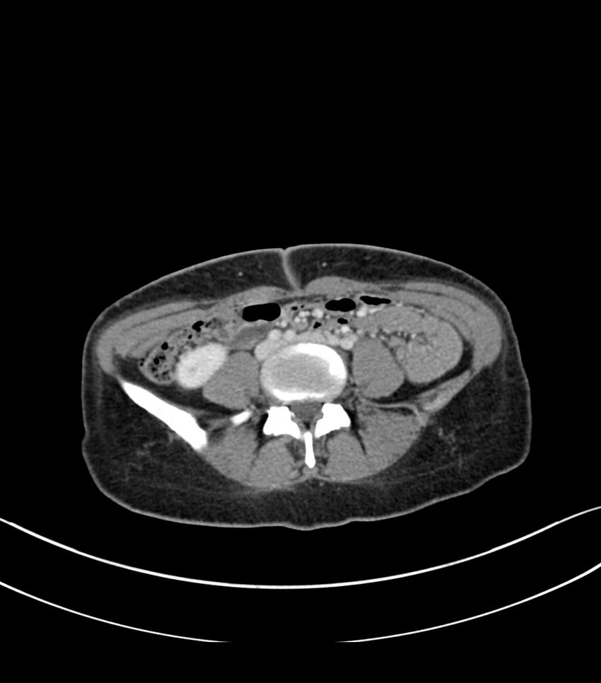 Bilateral kidney malrotation (Radiopaedia 72227-82749 A 45).jpg