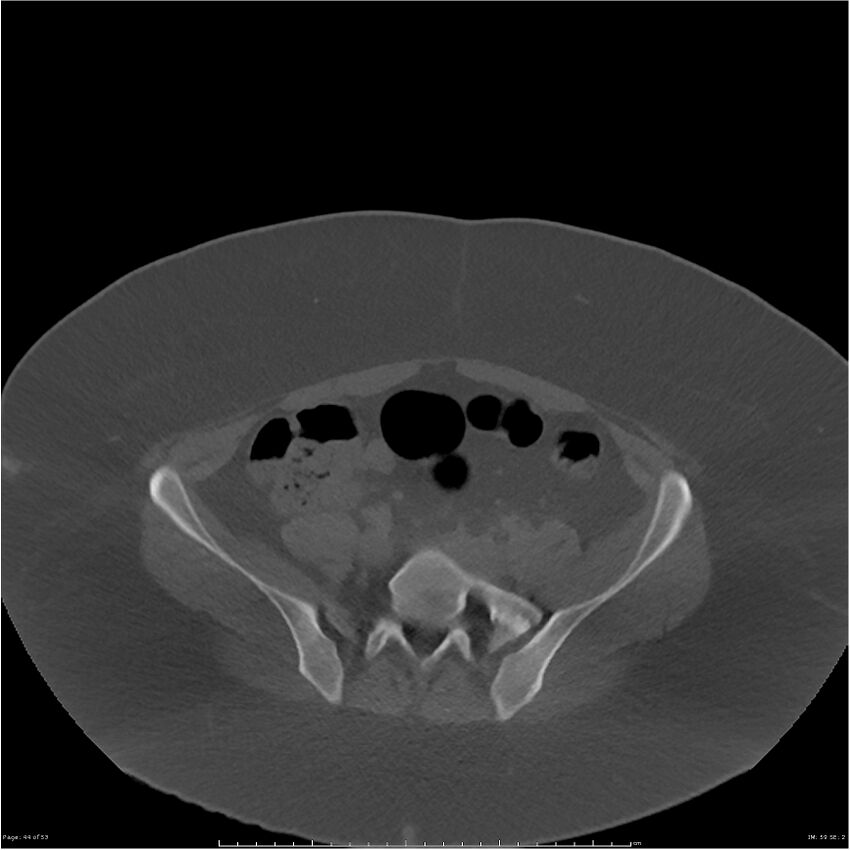 Bilateral lumbar ribs (Radiopaedia 25862-26010 bone window 44).jpg