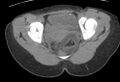 Bilateral mature cystic ovarian teratoma (Radiopaedia 88821-105592 Axial non-contrast 37).jpg