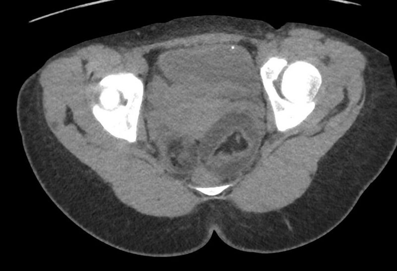 File:Bilateral mature cystic ovarian teratoma (Radiopaedia 88821-105592 Axial non-contrast 37).jpg