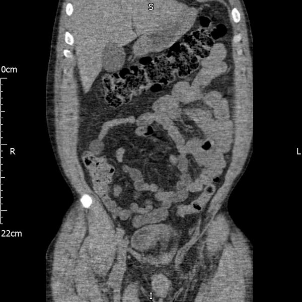 File:Bilateral medullary nephrocalcinosis with ureteric calculi (Radiopaedia 71269-81569 Coronal non-contrast 19).jpg