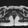 Bilateral ovarian endometriomas (Radiopaedia 87085-103347 Axial T2 22).jpg