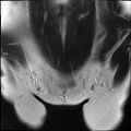 Bilateral ovarian endometriomas (Radiopaedia 87085-103347 Coronal T2 1).jpg
