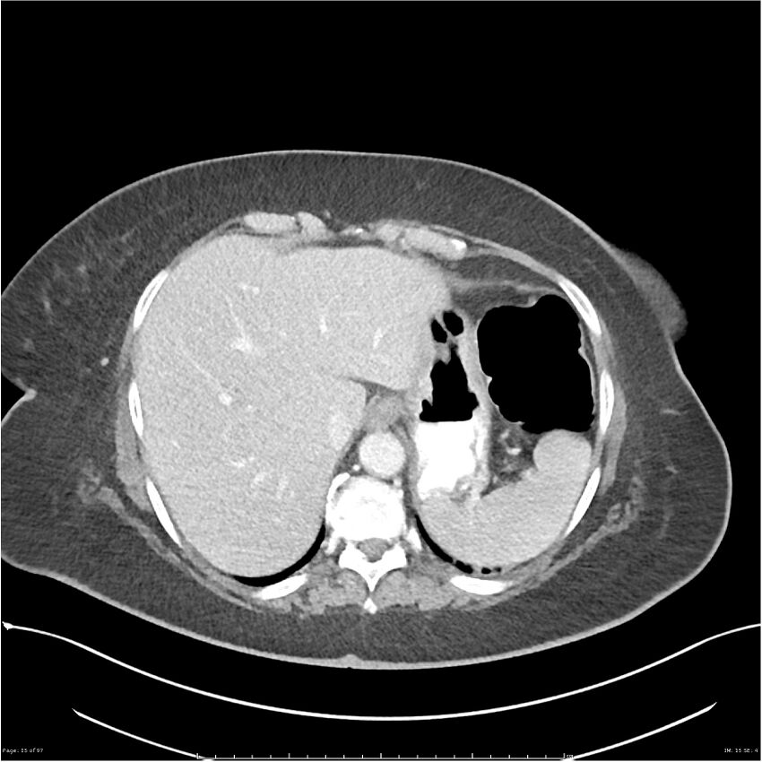 Bilateral psoas hematomas (Radiopaedia 24057-24279 A 15).jpg