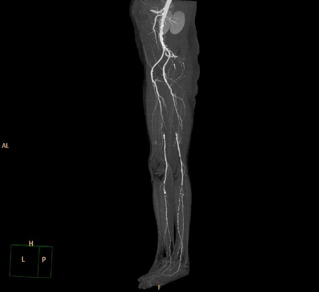 File:Bilateral superficial femoral arterial occlusion (Radiopaedia 25682-25857 3D MIP 18).jpg