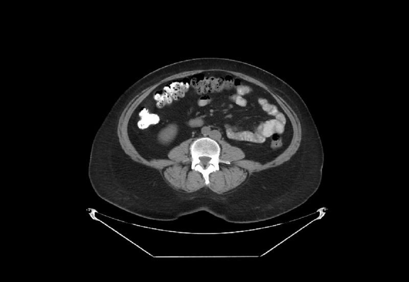 File:Bilateral urolithiasis with incidentally detected splenic artery aneurysm and left inferior vena cava (Radiopaedia 44467-48123 Axial non-contrast 32).jpg