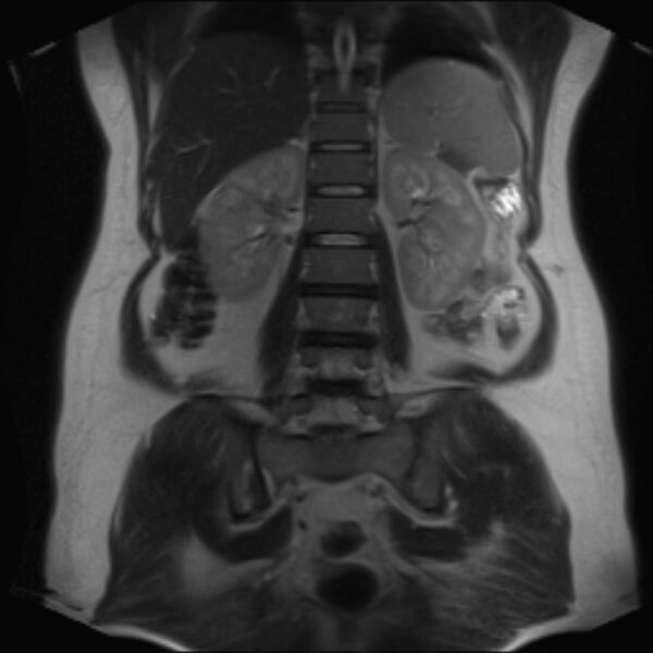 File:Bilobed placenta accreta (Radiopaedia 69648-79591 Coronal T2 28).jpg