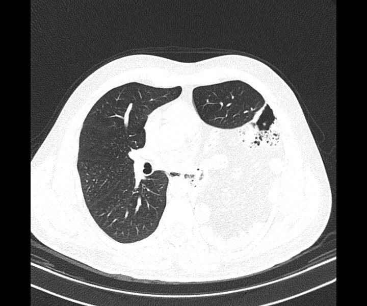 File:Bochdalek hernia - adult presentation (Radiopaedia 74897-85925 Axial lung window 23).jpg
