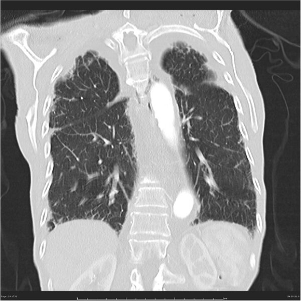 File:Boerhaave syndrome (Radiopaedia 26240-26362 Coronal lung window 24).jpg