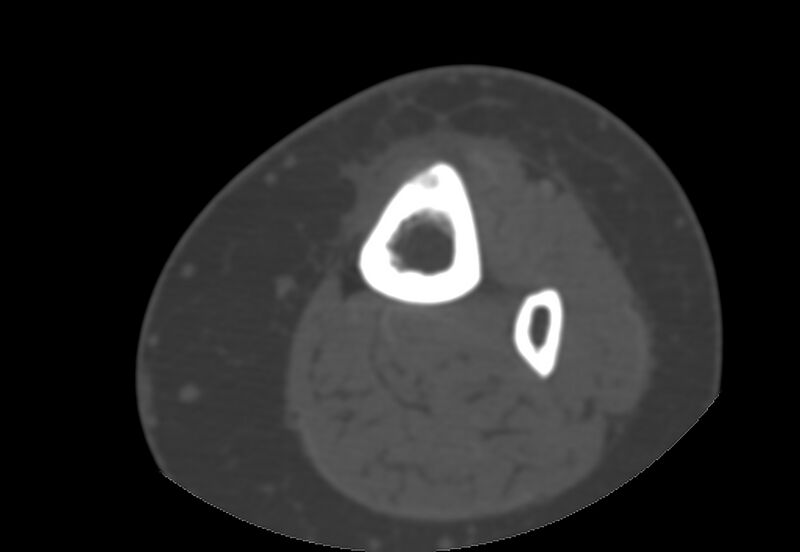 File:Bone metastasis - tibia (Radiopaedia 57665-64609 Axial bone window 19).jpg
