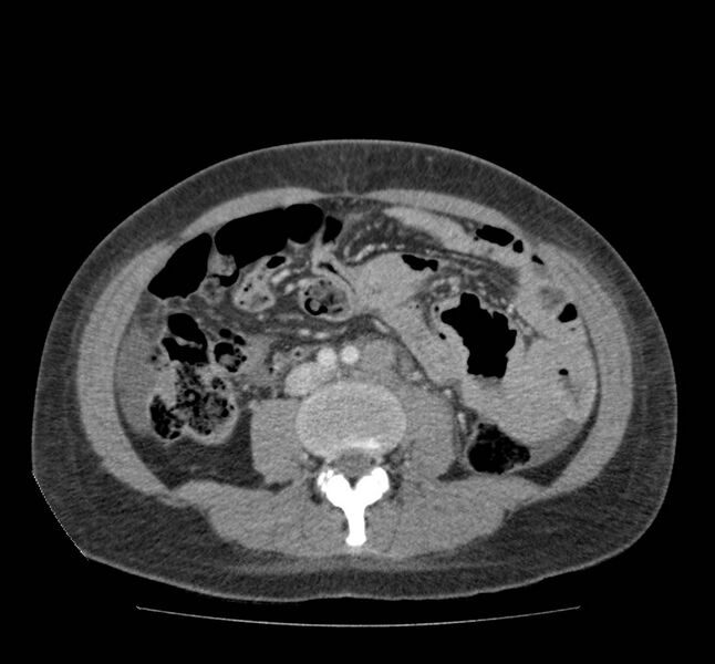 File:Bowel lymphoma complicated by bleeding after therapy (Radiopaedia 55601-62107 A 47).jpg