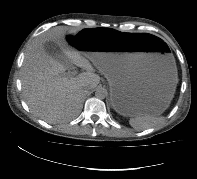File:Bowel lymphoma complicated by bleeding after therapy (Radiopaedia 55601-62110 Axial non-contrast 17).jpg